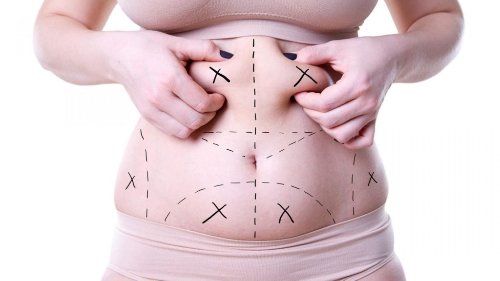 Liposuction-Surgery-What-It-Can-And-Cannot-Do-1024x576-1.jpg