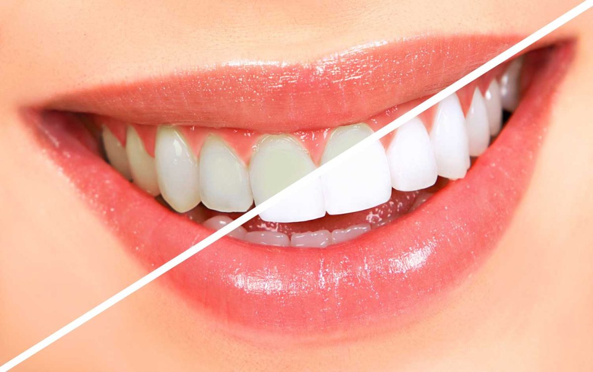 Teeth-Whitening-In-Lees-Summit_Eastridge-Family-Dental-1200x752.jpg