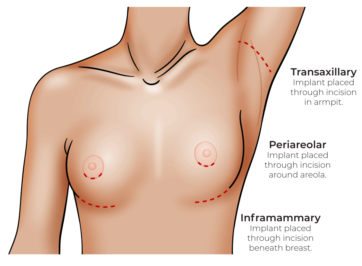 breast-implant-scars-1200x881.png
